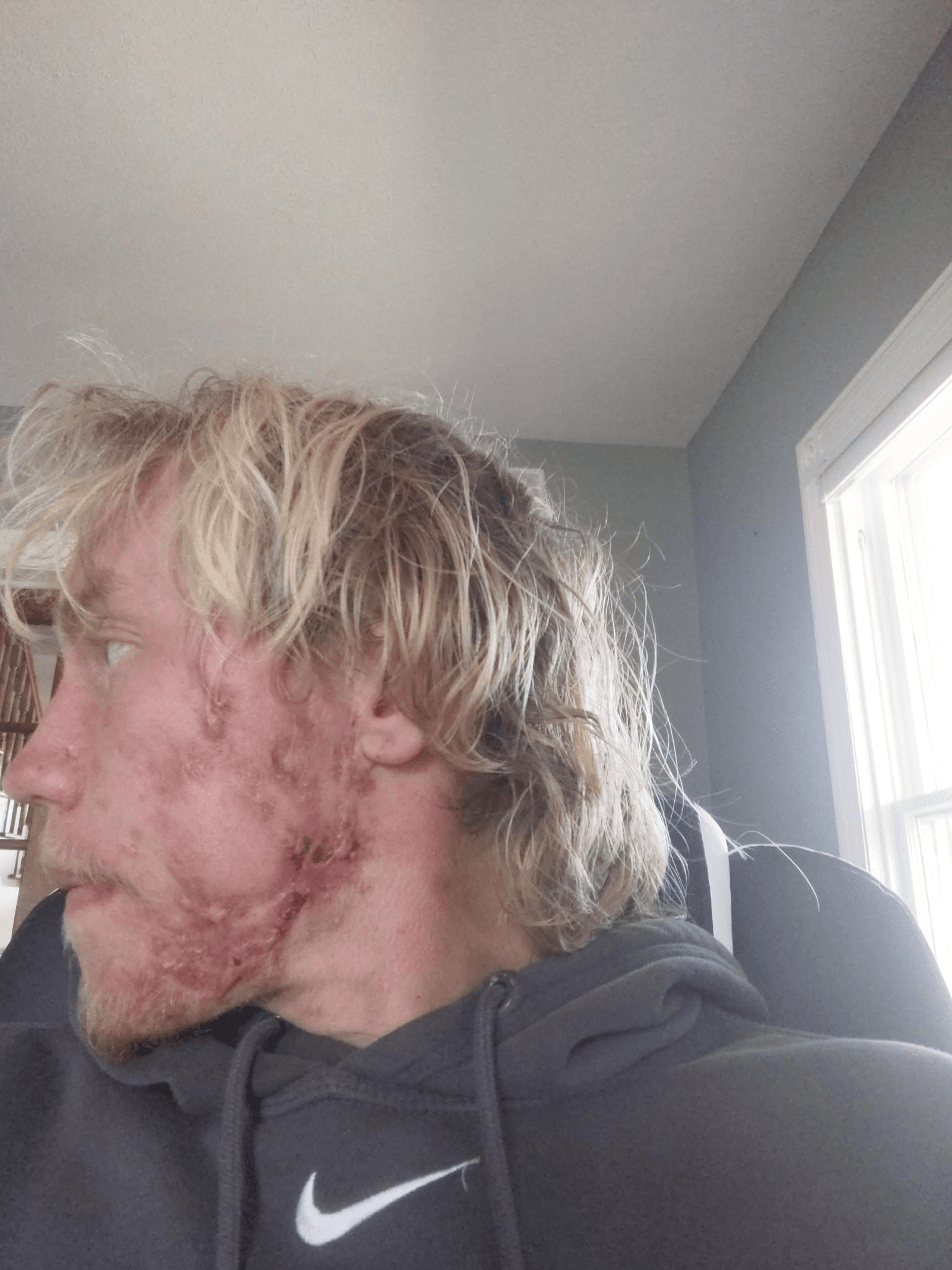 Hidradenitis Suppurativa